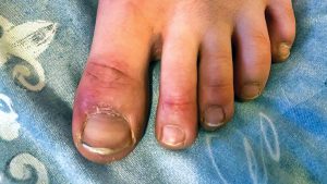 可怕!青少年患「新冠脚趾」 体内已遭病毒感染